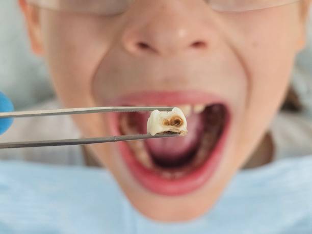 Best Emergency Wisdom Teeth Removal in Leavittsburg, OH